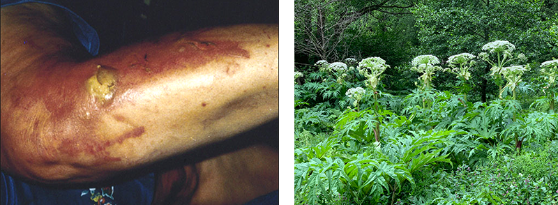 images of a human arm with a hogweed burn and a giant hogweed plant over five metres high